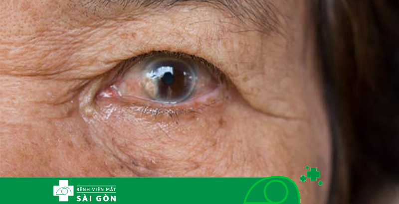 Tìm hiểu các bệnh lý gây mù loà và suy giảm thị lực ở người lớn tuổi